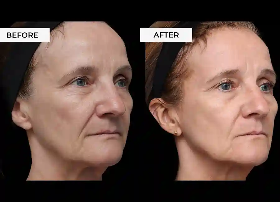 How Many RF Microneedling Sessions Will You Need to See a Difference Cirencester?