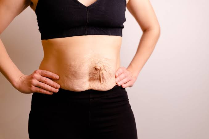 Is Surgery Really the Only Way to Repair Diastasis Recti Cirencester?