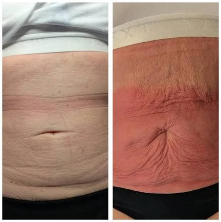 How Does RF Microneedling Improve Crepey, Thin and Uneven Skin Texture Cirencester?