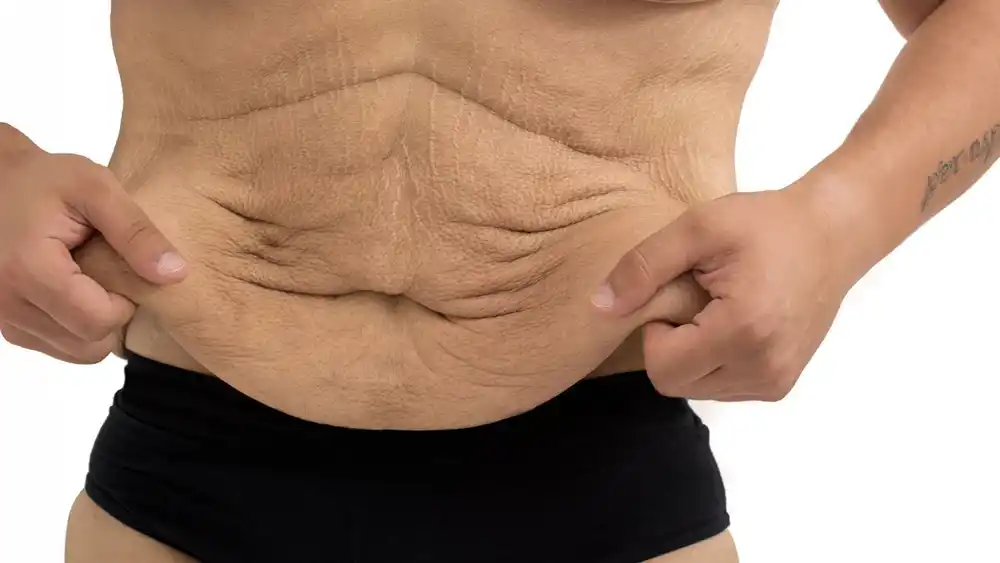 RF Microneedling for Loose Skin: How Can It Help Tighten and Reshape the Skin Cirencester?